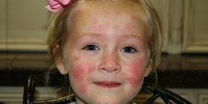 Лечение аллергии у детей